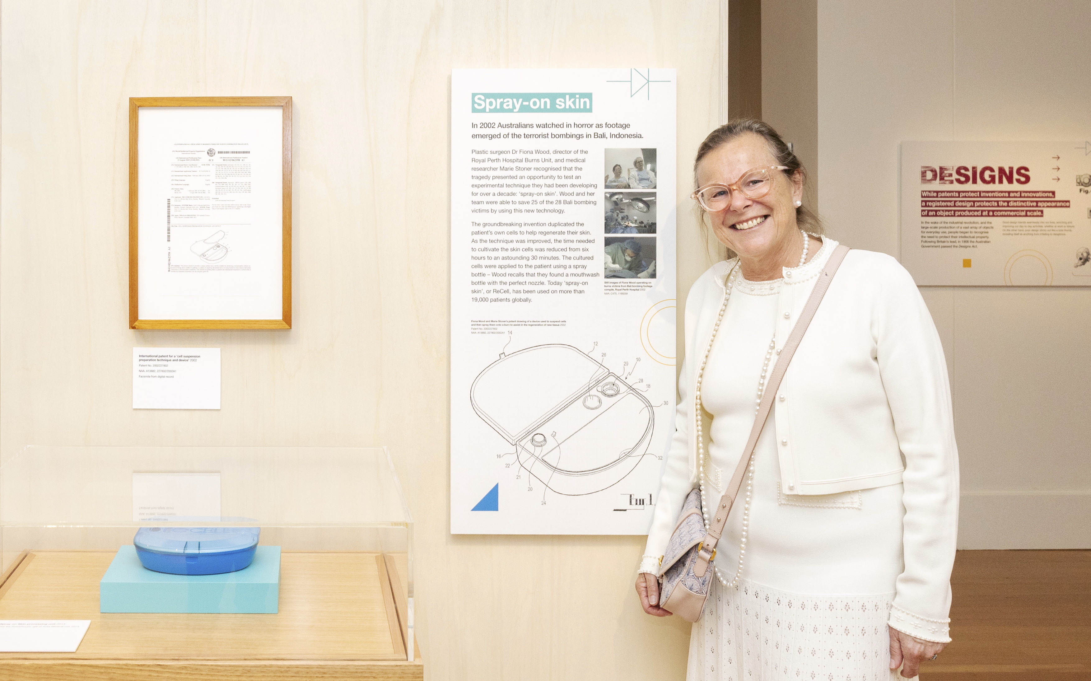 Image for Examples of deep partial thickness burns.