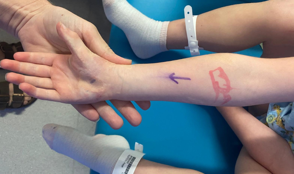 Image for Examples of deep partial thickness burns.