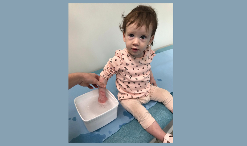 Image for Examples of deep partial thickness burns.