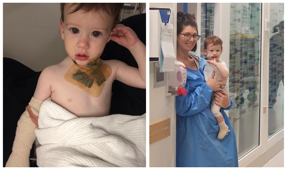 Image for Examples of deep partial thickness burns.