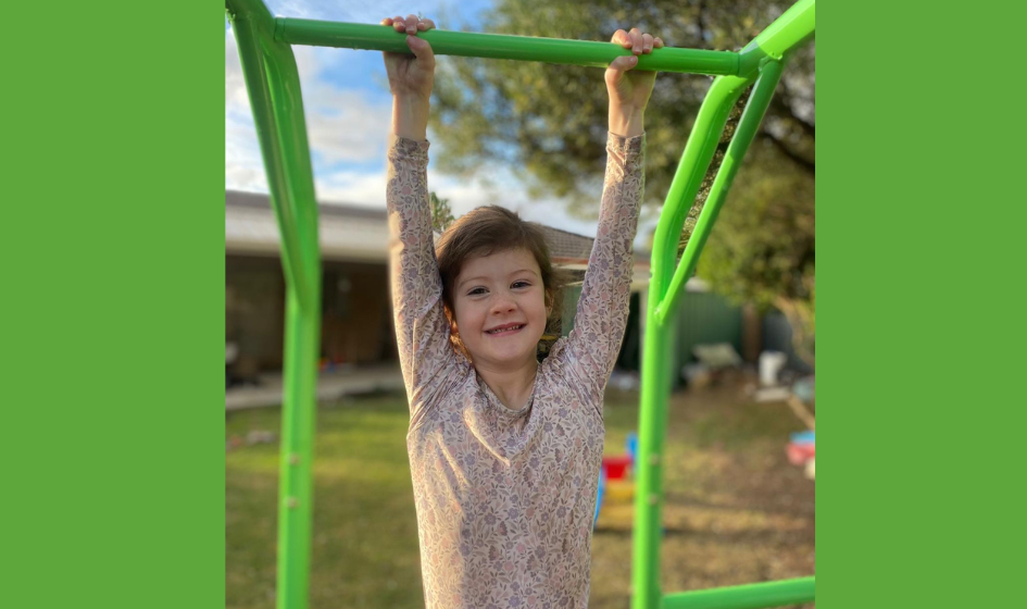 Image for Examples of deep partial thickness burns.